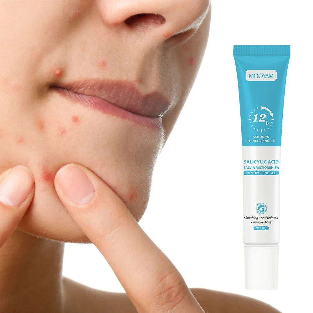 3 pcs Fast Effective Acne Gel 20gr