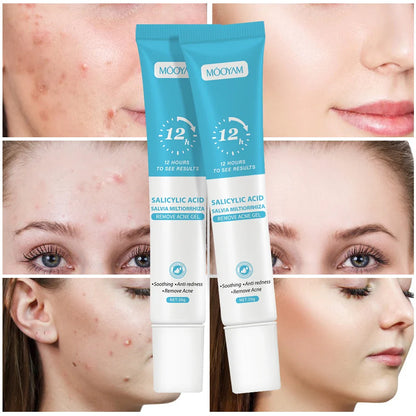 3 pcs Fast Effective Acne Gel 20gr