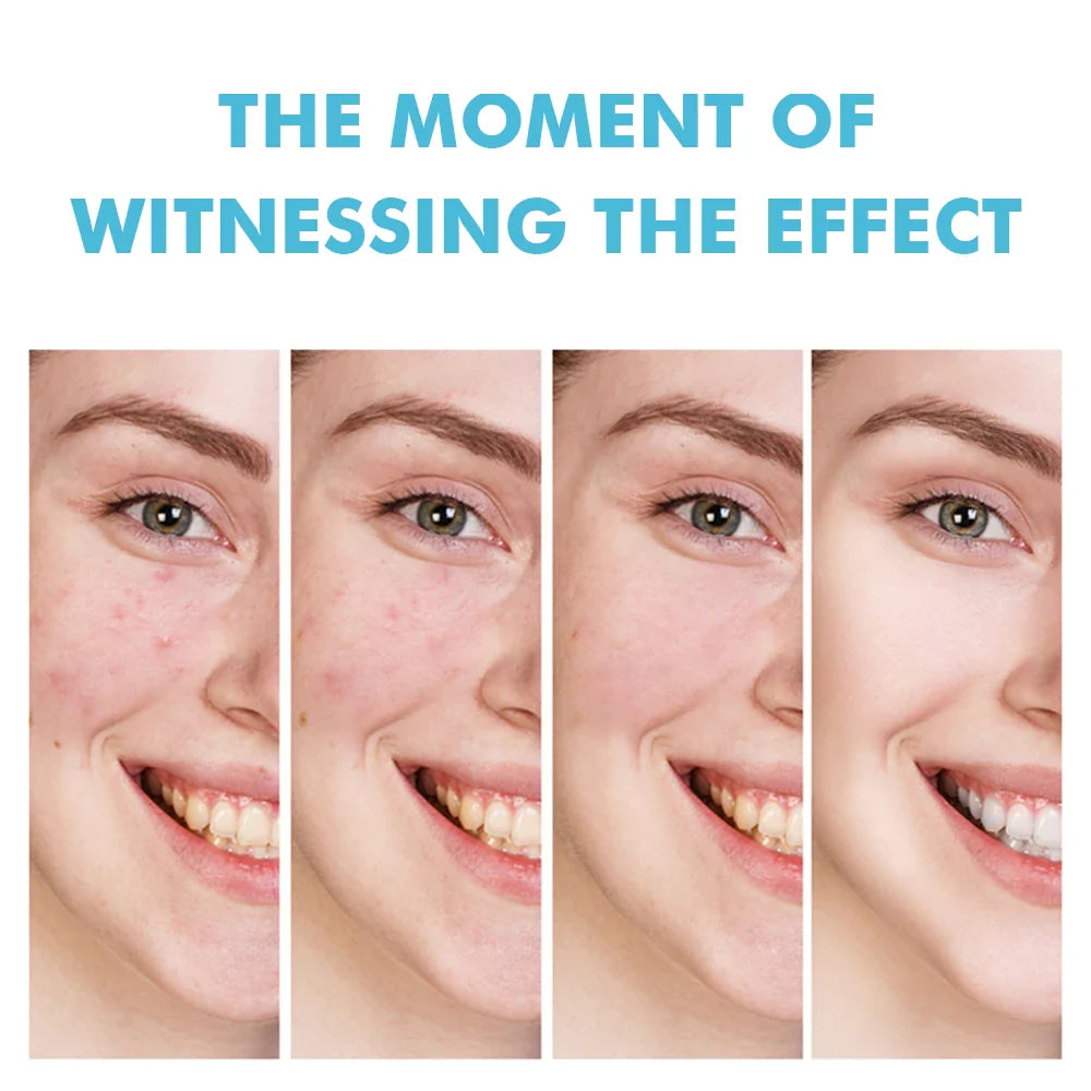 3 pcs Fast Effective Acne Gel 20gr