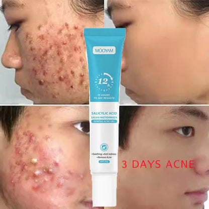 3 pcs Fast Effective Acne Gel 20gr