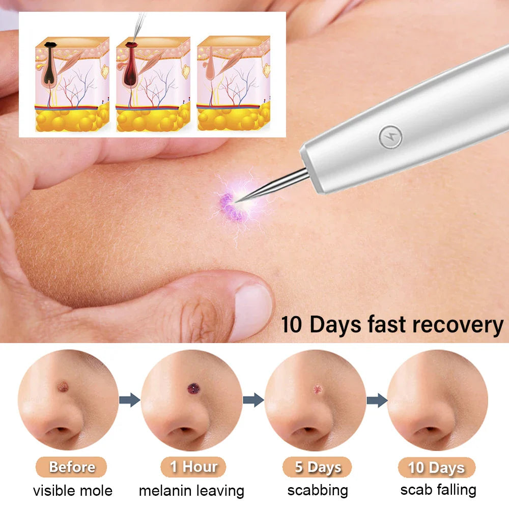 Skin tag remover Laser plasma pen Dark spot wart remover